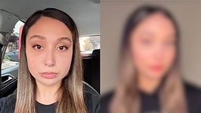 Incredible Face Slimming Journey: How Masseter Botox Transformed Her Square Jawline into a Perfect V-Shape!