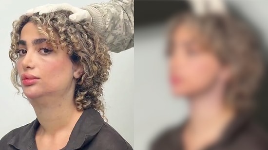 A Woman Shares Her Incredible Life-Changing Double Chin Surgery Transformation