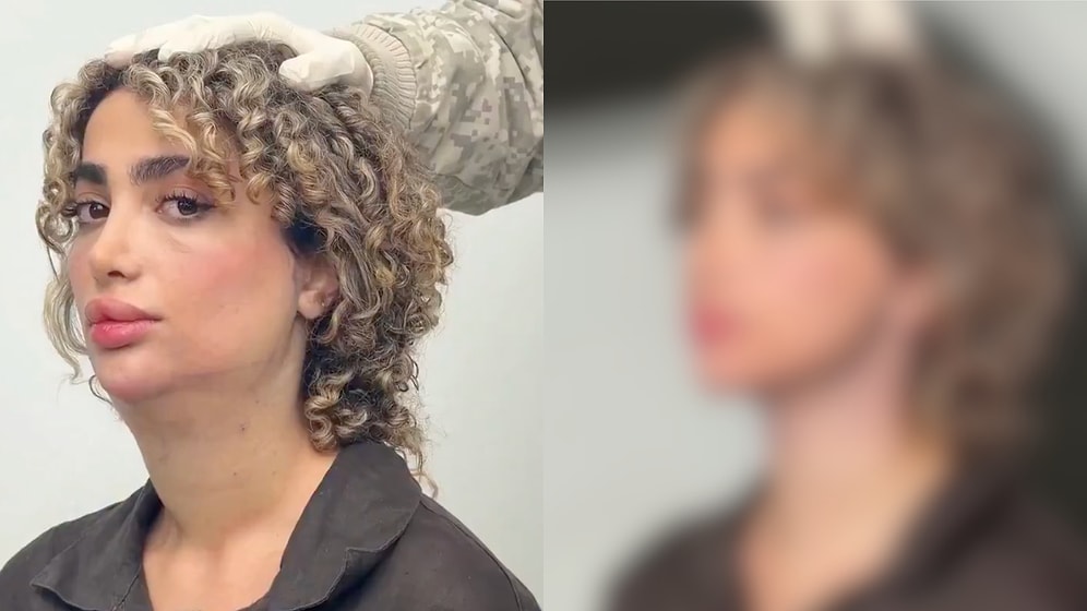 A Woman Shares Her Incredible Life-Changing Double Chin Surgery Transformation