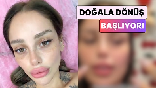 Doğala Dönüş Başlıyor! Bir Kadın Dudak Dolgusunu Eritme Sürecini Paylaştı