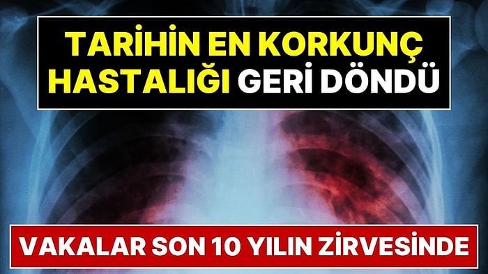 Tarihin En Korkunç Hastalığı Geri Döndü: COVID'den Daha Ölümcül Olabilir!