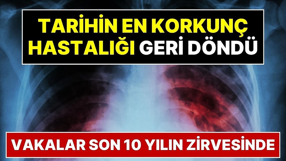 Tarihin En Korkunç Hastalığı Geri Döndü: COVID'den Daha Ölümcül Olabilir!