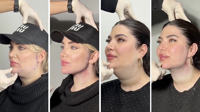 Renowned Surgeon Shares Incredible Before and After Transformations of Jowl Surgery Patients