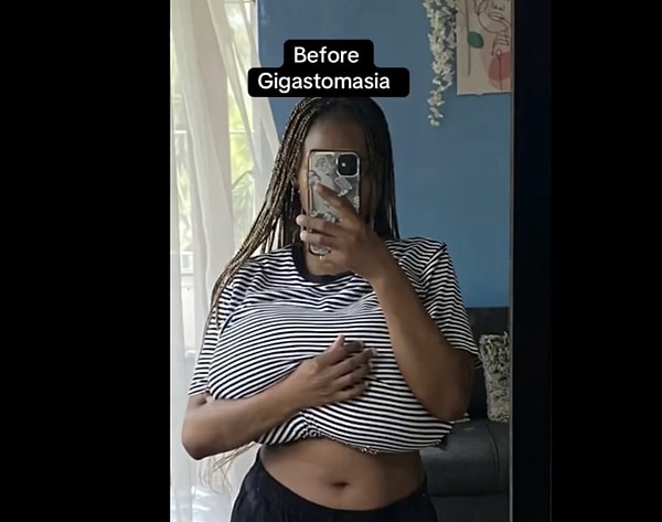 Peki gigantomasti ne anlama geliyor?