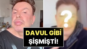Davul Gibi Şişmişti: Yüz Gerdirme Ameliyatı Olan Kuşum Aydın Son Halini Paylaştı!