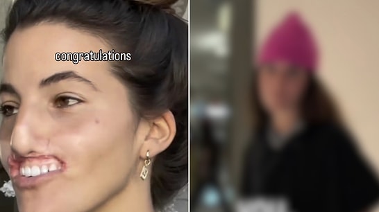 Woman Shares Her Incredible Transformation After Losing Upper Lip in Pitbull Attack