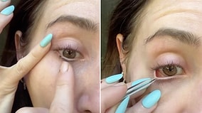 Outdoor Nightmare: Woman Shares Terrifying Footage of Removing a Tick From Her Own Eye