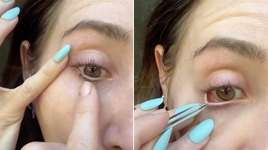Outdoor Nightmare: Woman Shares Terrifying Footage of Removing a Tick From Her Own Eye