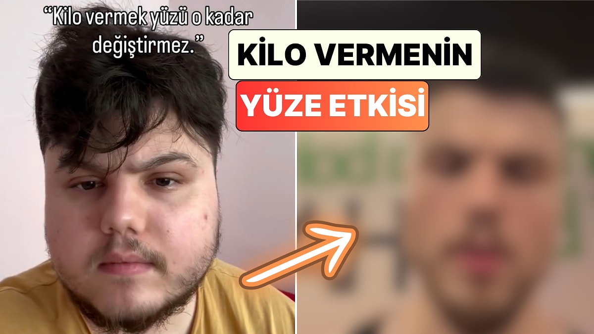 Ameliyatsız V-Line Etkisi: Kilo Veren Bir Genç Yüzünde Meydana Gelen Değişimi Paylaştı