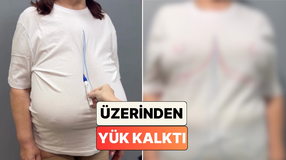 Meme Küçültme ve Dikleştirme Operasyonu Geçiren Bir Kadının Değişimi İzlerken Bile Rahatlattı