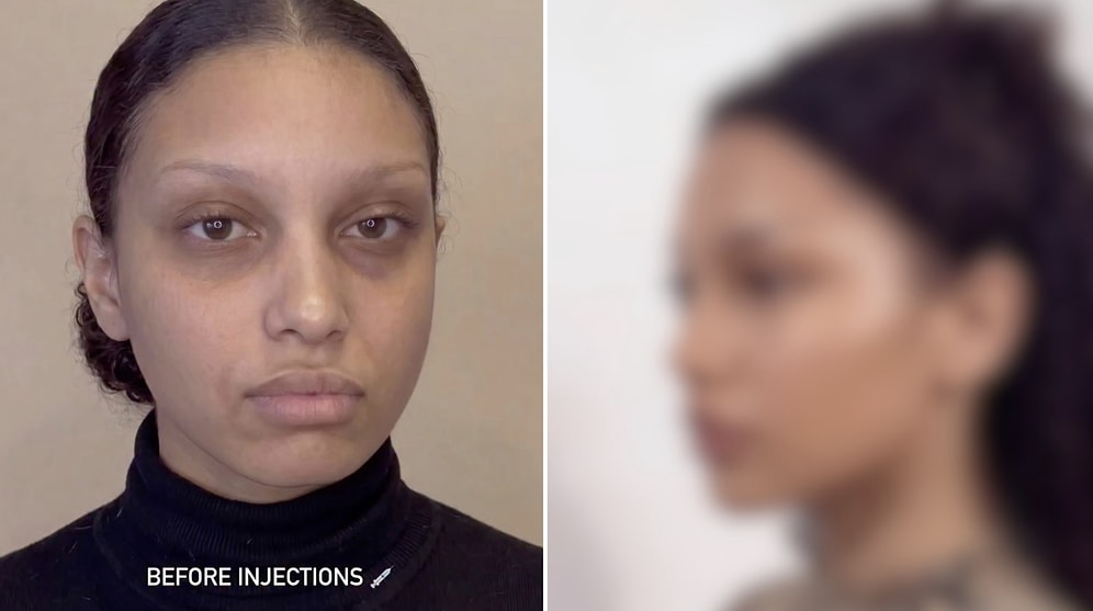 Unbelievable Change: Woman Sparks Debate With Shocking Facial Filler Transformation