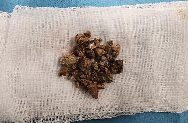 Yazın değişen beslenme alışkanlarımız da birer etken.