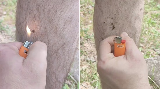 Don't Try This at Home: Man Uses Lighter to Remove Attached Tick and Stuns Viewers