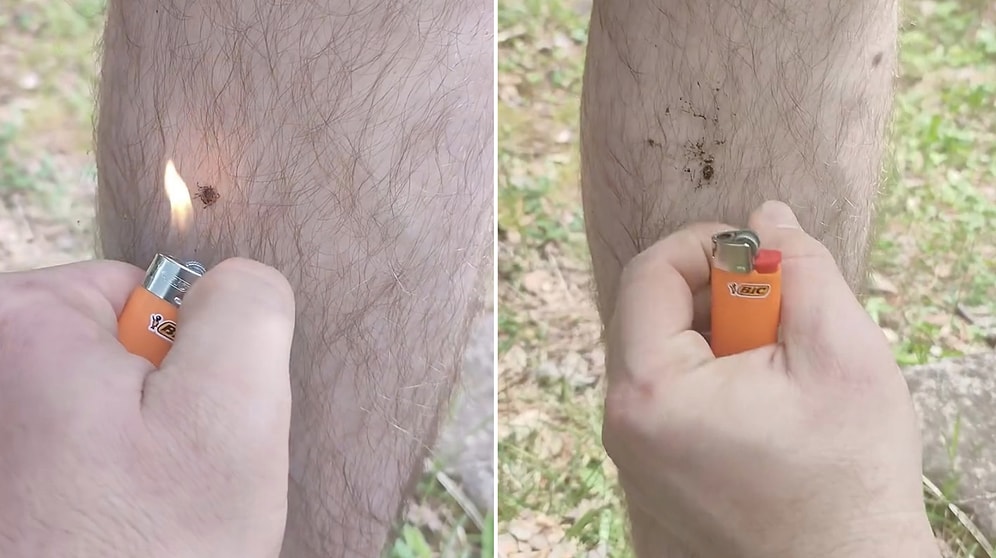 Don't Try This at Home: Man Uses Lighter to Remove Attached Tick and Stuns Viewers