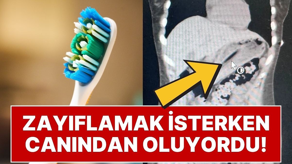 Zayıflamak İsterken Kabusu Yaşadı: İstanbul’da 21 Yaşındaki Kız 13 cm’lik Diş Fırçasını Yuttu