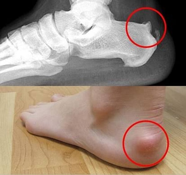 Cleats can cause deformation in the shape of the foot.