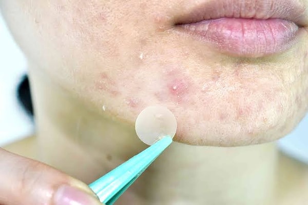 7. Sivilce Bantları (Hydrocolloid Patches)