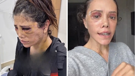 Didem Ceran Breaks Down After Cosmetic Procedure Nightmare Takes Another Dramatic Turn