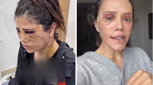 Didem Ceran's Cosmetic Surgery Ordeal