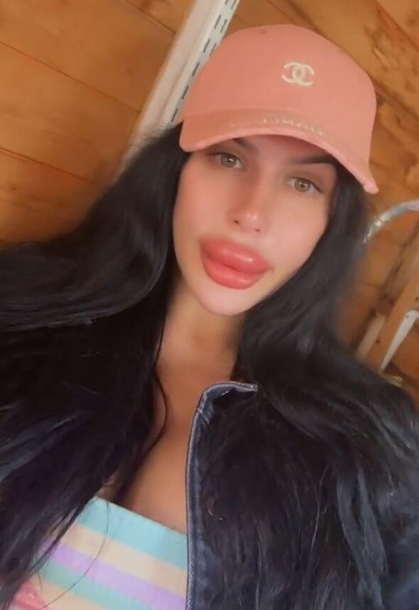 İngiltere'nin Manchester kentinde yaşayan 28 yaşındaki model Sofia Lips, aşırı dolgun dudaklarıyla uzun süredir gündemde.