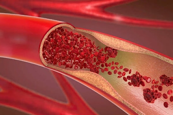 Atherosclerosis, a condition characterized by the hardening and narrowing of arteries, is a leading cause of death in developed countries and globally. Alarmingly, it can progress over many years without showing any symptoms.