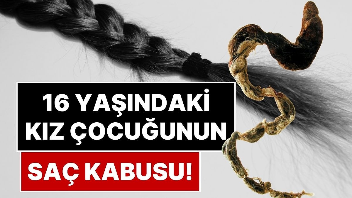 Nadir Görülen 'Rapunzel Sendromu' Ameliyat Gerektirecek Kadar Büyük Bir Saç Yumağına Neden Olabiliyor