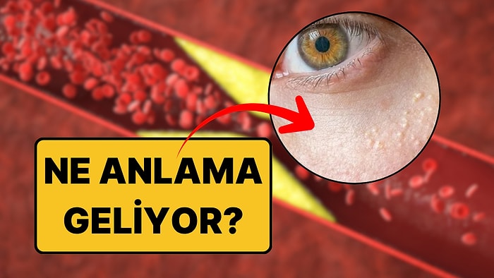 Göz Çevresindeki Sarı Lekeler Tehlikeyi Haber Veriyor: Kalple İlişkisi Ortaya Çıktı