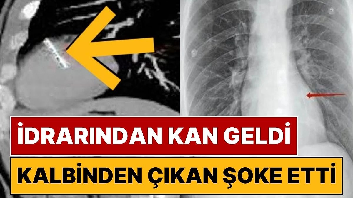 İdrarından Kan Gelen Adamın Röntgeninde Şoke Eden Detay: Kalbinden 36 Milimetrelik İğne Çıktı