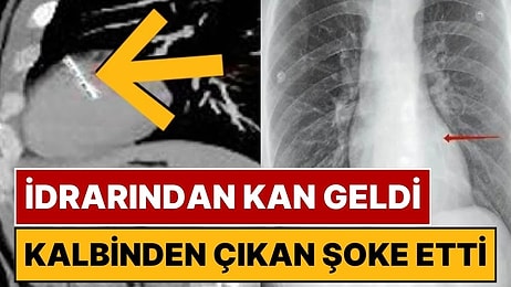 İdrarından Kan Gelen Adamın Röntgeninde Şoke Eden Detay: Kalbinden 36 Milimetrelik İğne Çıktı