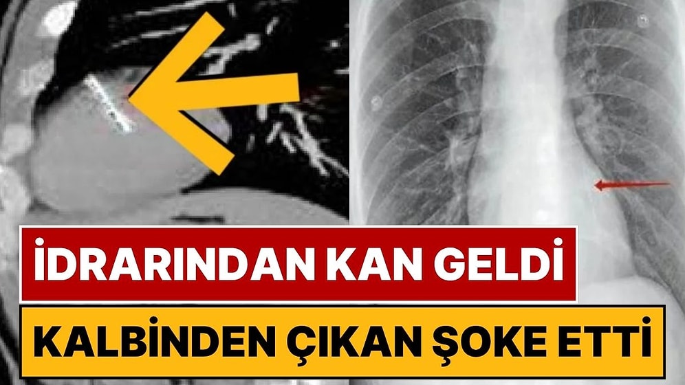 İdrarından Kan Gelen Adamın Röntgeninde Şoke Eden Detay: Kalbinden 36 Milimetrelik İğne Çıktı