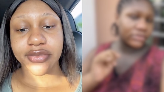 Woman Shares Shocking Facial Transformation She Experienced During Pregnancy