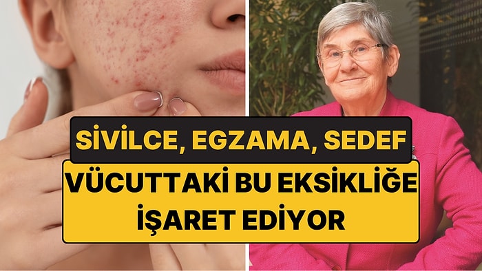 Sivilce, Egzama ve Sedef Bu Eksikliğe İşaret Ediyor: Canan Karatay Bağışıklık İçin Uyardı