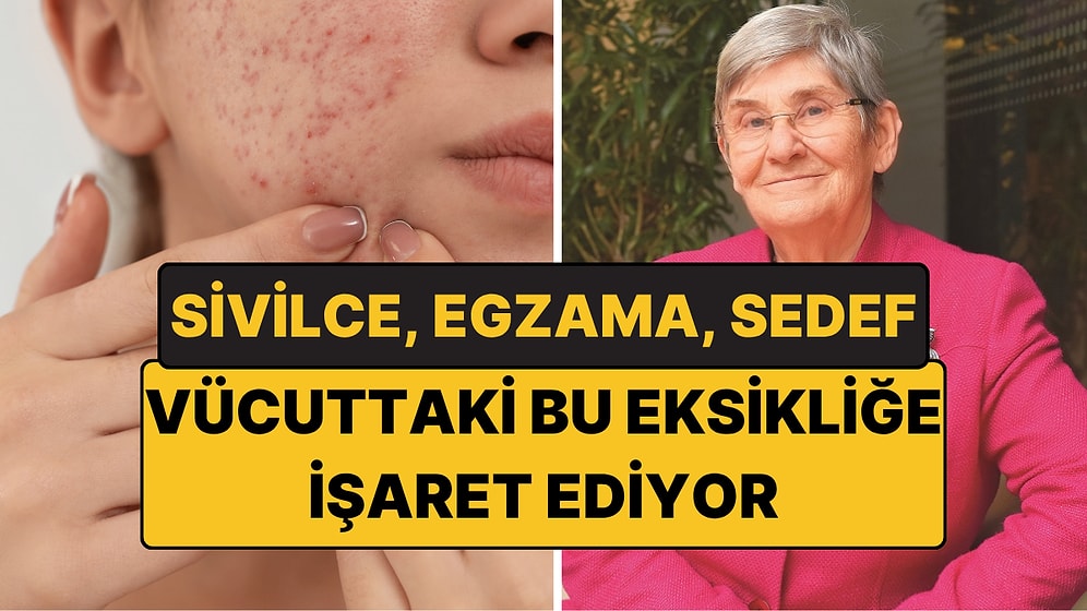 Sivilce, Egzama ve Sedef Bu Eksikliğe İşaret Ediyor: Canan Karatay Bağışıklık İçin Uyardı