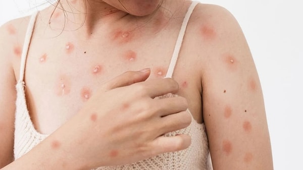 Memişoğlu şöyle devam etti: "Covid gibi salgına sebebiyet vermeyeceği, olsa dahi pandemi oluşmayacağı yönünde kanaat var. Tek tük görülebilir; ama bu salgın olmaz. Şu ada ekstra bir tedbire ihtiyacımız yok."